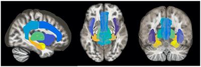 Pre-operative Limbic System Functional Connectivity Distinguishes Responders From Non-responders to Surgical Treatment for Trigeminal Neuralgia